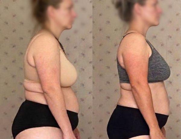 Roberta Before and After Fascia Release